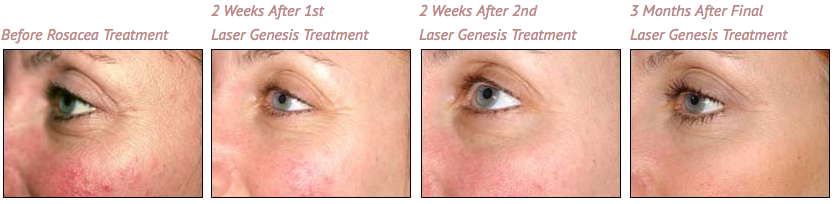 Rosacea treatment at Timeless Laser and Skin Care