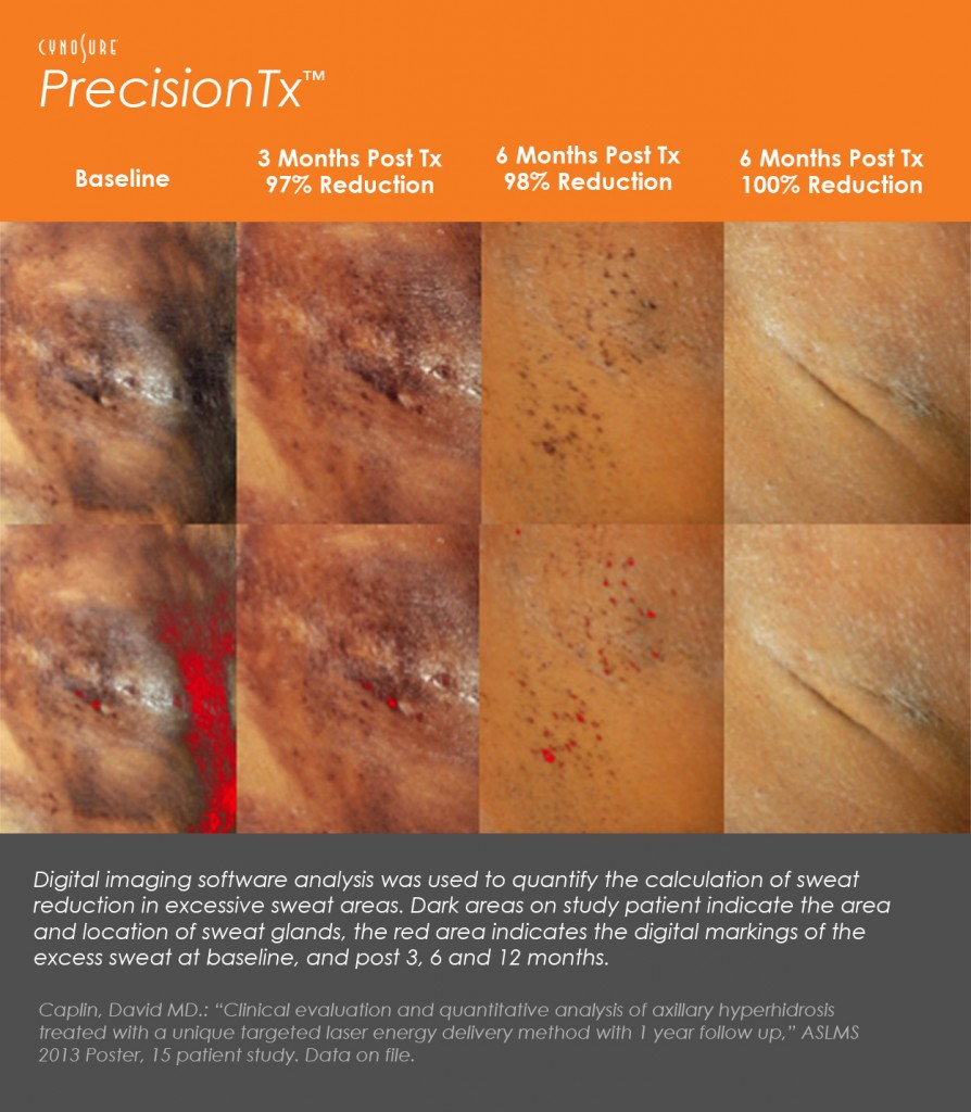 Get rid of Hyperhidrosis with Precision TX