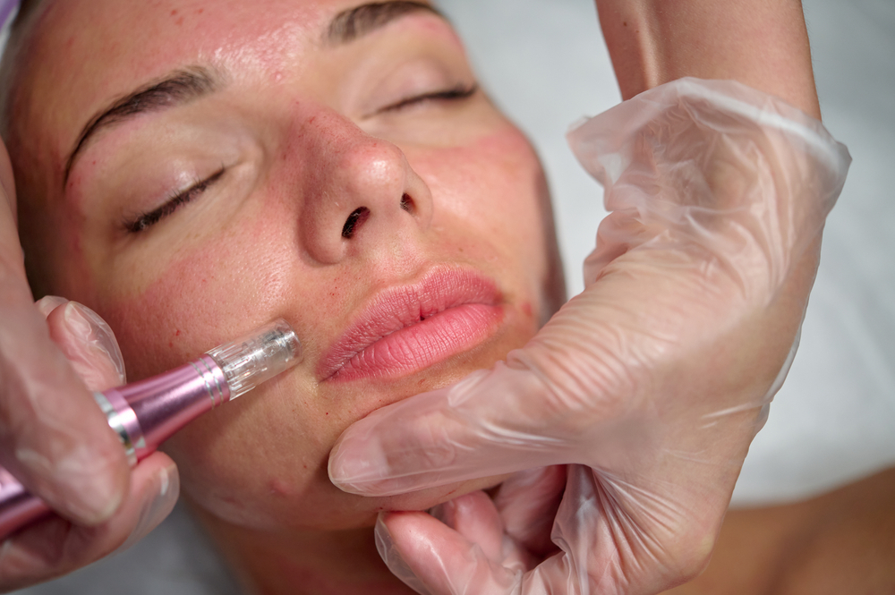 How Long Does Microneedling Take