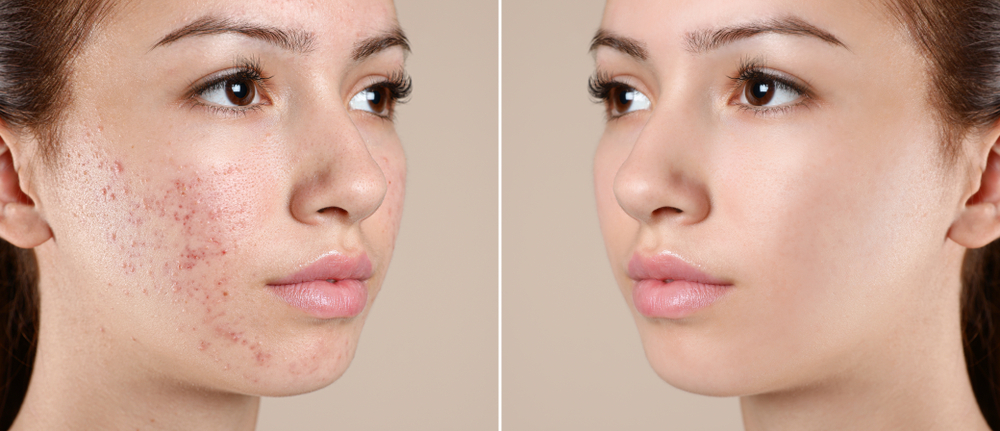 How to Prevent Acne Scarring: Tips for Minimizing Future Scars | Timeless Laser & Skin Care