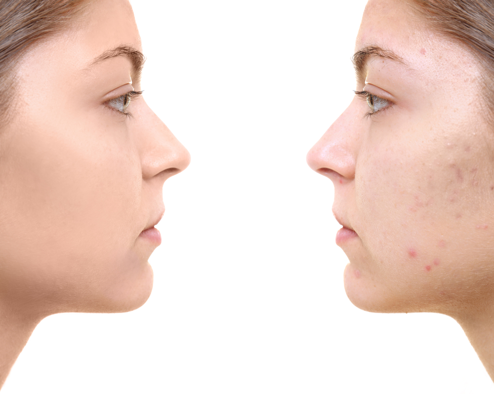 What Are the Most Effective Treatments for Different Types of Acne Scars? | Timeless Laser & Skin Care