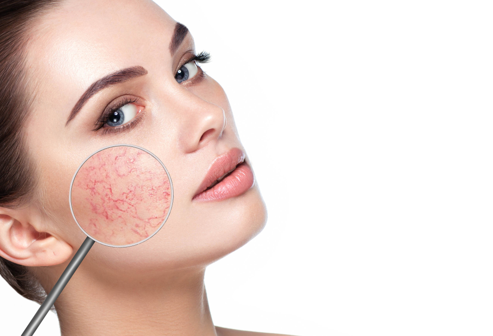 Unmasking Rosacea: Understanding Its Signs, Symptoms & Treatment | Timeless Laser & Skin Care